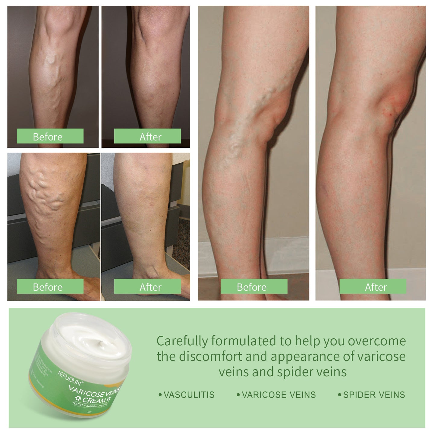 Vein Cream Red Blood Streaks Repair Earthworm Leg Bruises Bulge Relief Pain Safflower Skin care lotion Varicose Cream - Health and Wellness Innovations